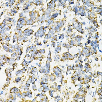 Immunohistochemistry: Adenylosuccinate Synthase Antibody - BSA Free [NBP2-92661] - Immunohistochemistry analysis of paraffin-embedded Human lung cancer using Adenylosuccinate Synthase Rabbit pAb  at dilution of 1:100 (40x lens). Microwave antigen retrieval performed with 0.01M PBS Buffer (pH 7.2) prior to IHC staining.