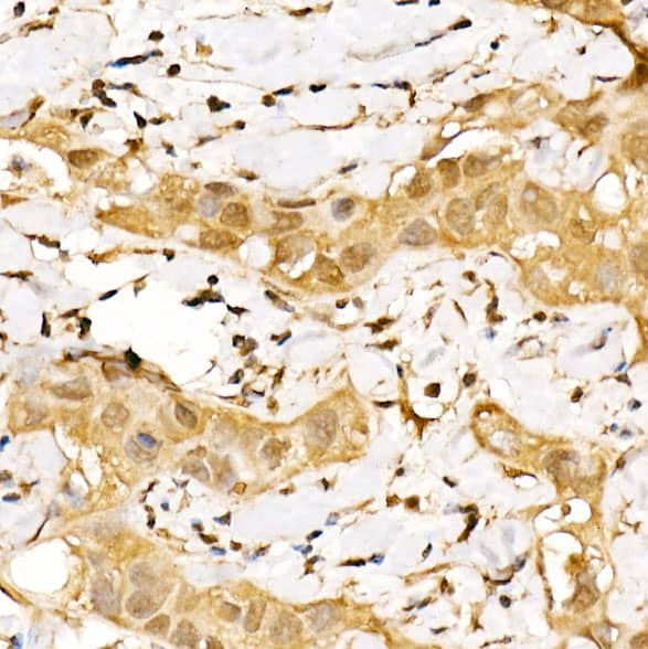 Immunohistochemistry: CSN1 Antibody - BSA Free [NBP2-92907] - Immunohistochemistry analysis of paraffin-embedded Human breast cancer using CSN1 Rabbit pAb  at dilution of 1:200 (40x lens). Perform high pressure antigen retrieval with 10 mM citrate buffer pH 6.0 before commencing with IHC staining protocol.