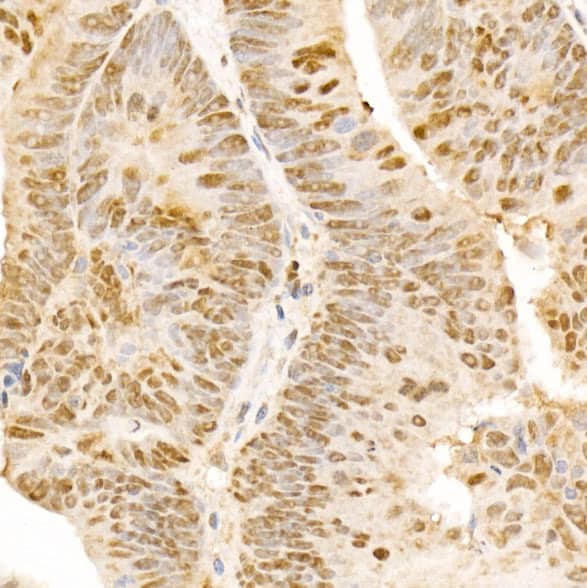 Immunohistochemistry: POLD3 Antibody - BSA Free [NBP2-93032] - Immunohistochemistry analysis of paraffin-embedded Human colon carcinoma using POLD3 Rabbit pAb  at dilution of 1:300 (40x lens). Microwave antigen retrieval performed with 0.01M PBS Buffer (pH 7.2) prior to IHC staining.