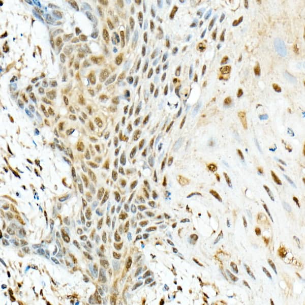 Immunohistochemistry: Virilizer Antibody - Azide and BSA Free [NBP2-93159] - Immunohistochemistry analysis of paraffin-embedded human esophageal cancer using Virilizer Rabbit pAb  at dilution of 1:200 (40x lens).Perform high pressure antigen retrieval with 10 mM citrate buffer pH 6.0 before commencing with IHC staining protocol.