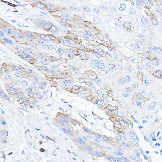 Immunohistochemistry: TMPRSS2 Antibody - Azide and BSA Free [NBP2-93322] - Immunohistochemistry analysis of paraffin-embedded Human esophageal cancer using TMPRSS2 Rabbit pAb  at dilution of 1:50 (40x lens). High pressure antigen retrieval performed with 0.01M Citrate Bufferr (pH 6.0) prior to IHC staining.