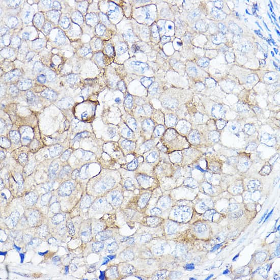 Immunohistochemistry: TMPRSS2 Antibody - Azide and BSA Free [NBP2-93322] - Immunohistochemistry analysis of paraffin-embedded Human breast cancer using TMPRSS2 Rabbit pAb  at dilution of 1:50 (40x lens). High pressure antigen retrieval performed with 0.01M Citrate Bufferr (pH 6.0) prior to IHC staining.