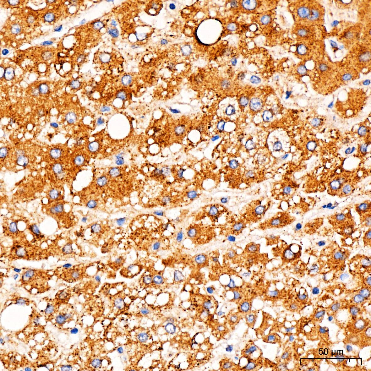 Immunohistochemistry: TOMM6 Antibody - BSA Free [NBP2-93442] - Immunohistochemistry analysis of TOMM6 in paraffin-embedded human liver cancer tissue using TOMM6 Rabbit pAb  at a dilution of 1:100 (40x lens). High pressure antigen retrieval was performed with 0.01 M citrate buffer (pH 6.0) prior to IHC staining.