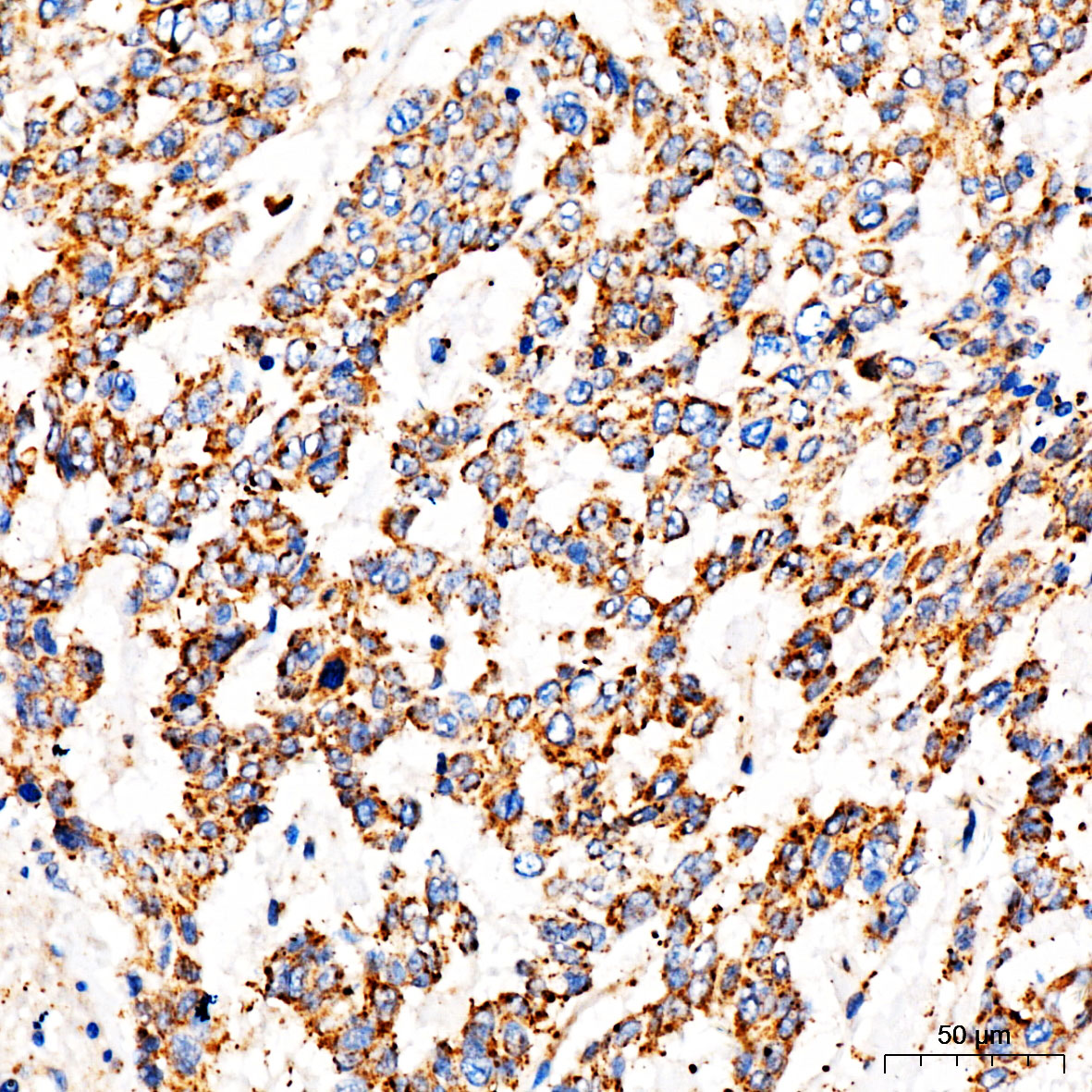 Immunohistochemistry: TOMM6 Antibody - BSA Free [NBP2-93442] - Immunohistochemistry analysis of TOMM6 in paraffin-embedded human lung cancer tissue using TOMM6 Rabbit pAb  at a dilution of 1:100 (40x lens). High pressure antigen retrieval was performed with 0.01 M citrate buffer (pH 6.0) prior to IHC staining.