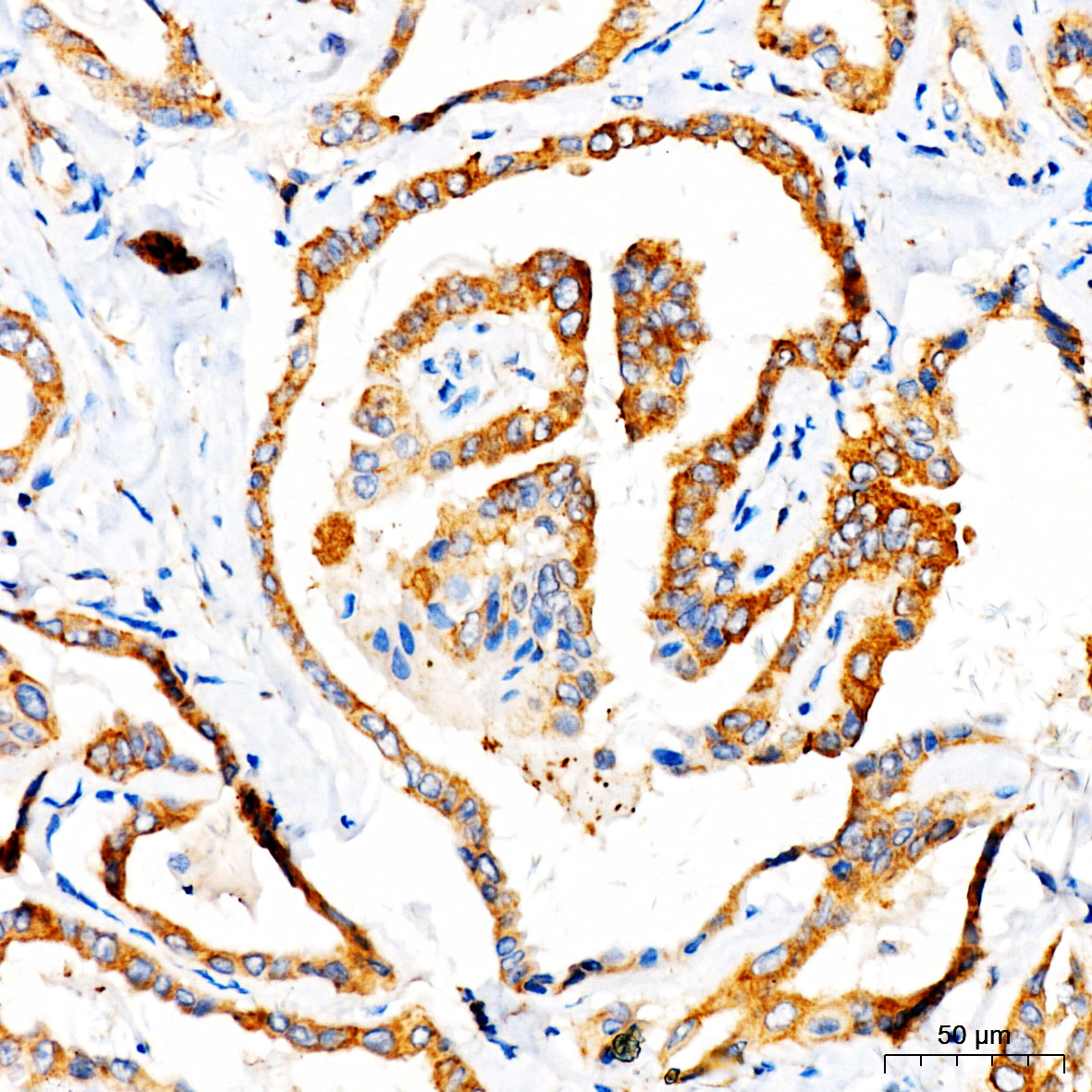Immunohistochemistry: TOMM6 Antibody - BSA Free [NBP2-93442] - Immunohistochemistry analysis of TOMM6 in paraffin-embedded human thyroid cancer tissue using TOMM6 Rabbit pAb  at a dilution of 1:100 (40x lens). High pressure antigen retrieval was performed with 0.01 M citrate buffer (pH 6.0) prior to IHC staining.