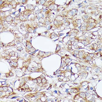 Immunohistochemistry: SLC7A2 Antibody - Azide and BSA Free [SLC7A2] - Immunohistochemistry analysis of paraffin-embedded Human mammary cancer using SLC7A2 Rabbit pAb  at dilution of 1:100 (40x lens). Microwave antigen retrieval performed with 0.01M PBS Buffer (pH 7.2) prior to IHC staining.