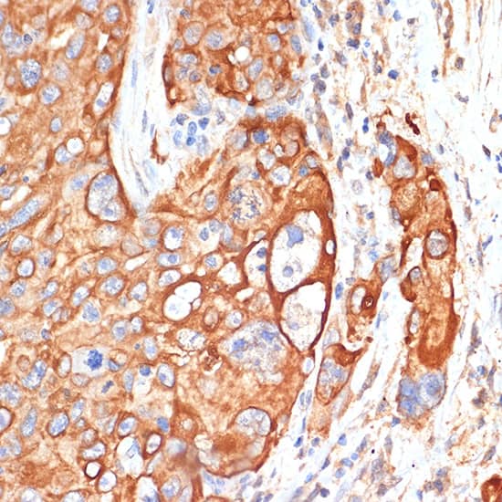 Immunohistochemistry: RB1CC1 Antibody - Azide and BSA Free [RB1CC1] - Immunohistochemistry analysis of paraffin-embedded human lung cancer using RB1CC1 Rabbit pAb  at dilution of 1:100 (40x lens).Perform microwave antigen retrieval with 10 mM Tris/EDTA buffer pH 9.0 before commencing with IHC staining protocol.