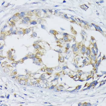 Immunohistochemistry: SLC30A1 Antibody - BSA Free [SLC30A1] - Immunohistochemistry analysis of paraffin-embedded Human mammary cancer using SLC30A1 Rabbit pAb  at dilution of 1:100 (40x lens). Microwave antigen retrieval performed with 0.01M PBS Buffer (pH 7.2) prior to IHC staining.