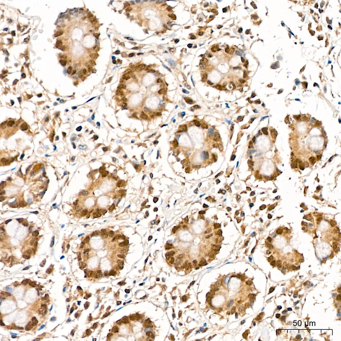 Immunohistochemistry: TRMT61A Antibody - Azide and BSA Free [TRMT61A] - Immunohistochemistry analysis of paraffin-embedded Human colon tissue using TRMT61A Rabbit pAb  at a dilution of 1:200 (40x lens). High pressure antigen retrieval performed with 0.01M Citrate Bufferr (pH 6.0) prior to IHC staining.