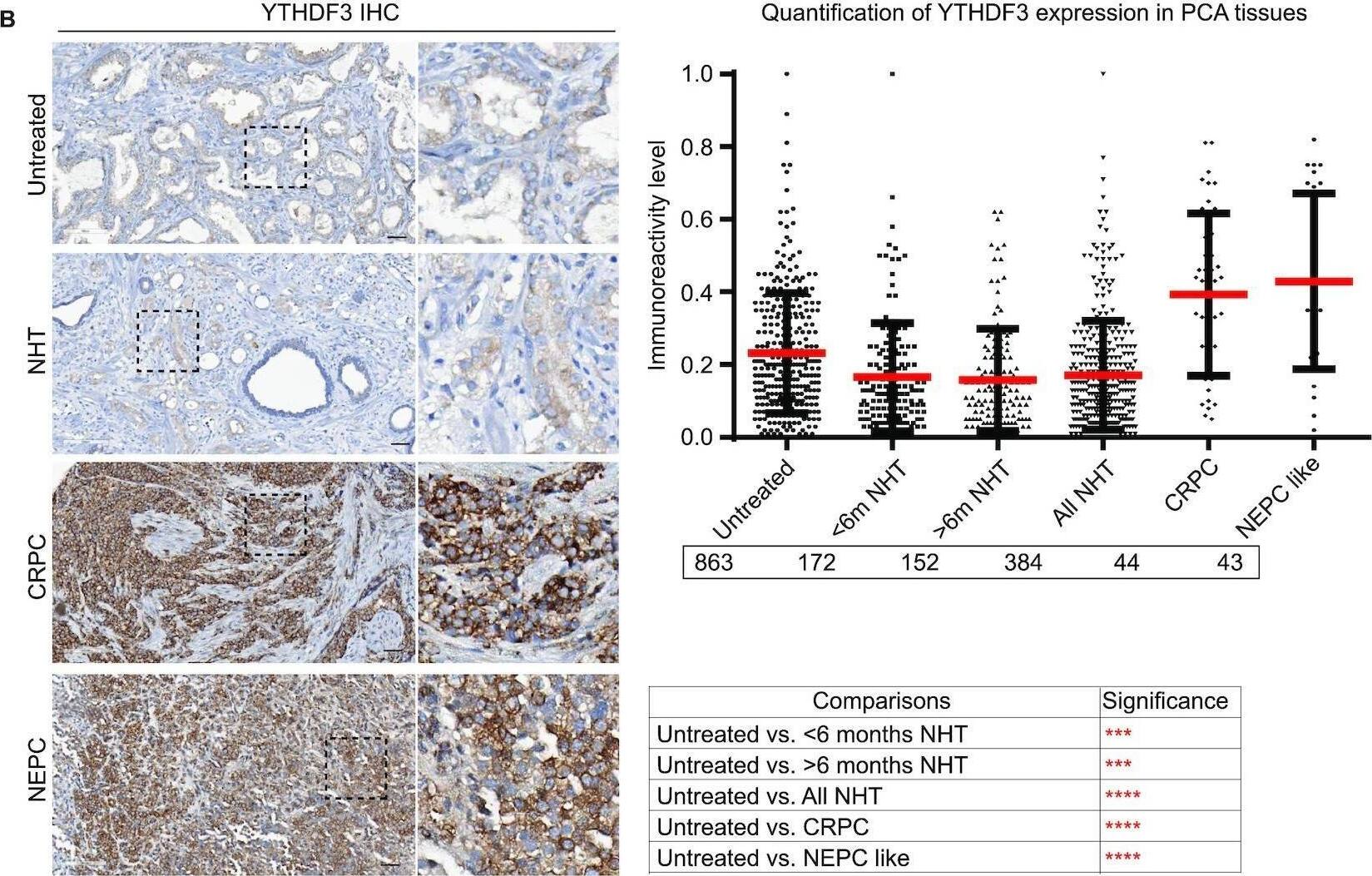 Immunohistochemistry (IHC) analysis of G3BP1 and YTHDF3 in PCA TMAs. PCA tissue microarrays (TMAs) were stained with anti-G3BP1 (A) and anti-YTHDF3 (B) antibodies. A part of the image is enlarged and shown. Quantification of staining is shown on the right-side panels. Statistics of quantification data is presented below respective graphs. Note that G3BP1 expression is increased in ARPI stressed, CRPC and NEPC tissues, while YTHDF3 expression is enhanced in CRPC and NEPC tissues. NHT: neoadjuvant hormonal therapy; CRPC: castration resistant PCA; NEPC: neuroendocrine PCA. Image collected and cropped by CiteAb from the following open publication (//pubmed.ncbi.nlm.nih.gov/34939643), licensed under a CC-BY license. Not internally tested by Novus Biologicals.