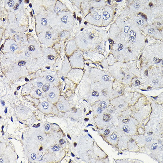 Immunohistochemistry: Notch-1 Antibody - Azide and BSA Free [Notch-1] - Immunohistochemistry analysis of paraffin-embedded Human liver cancer using Notch-1 Rabbit pAb  at dilution of 1:100 (40x lens). High pressure antigen retrieval performed with 0.01M Citrate Bufferr (pH 6.0) prior to IHC staining.