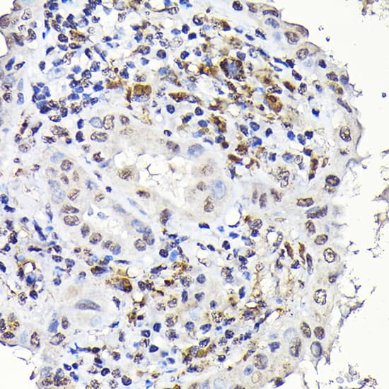 Immunohistochemistry: Notch-1 Antibody - Azide and BSA Free [Notch-1] - Immunohistochemistry analysis of paraffin-embedded Human thyroid cancer using Notch-1 Rabbit pAb  at dilution of 1:100 (40x lens). High pressure antigen retrieval performed with 0.01M Citrate Bufferr (pH 6.0) prior to IHC staining.