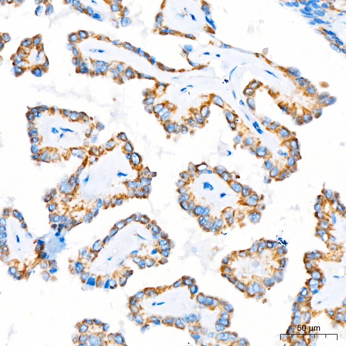Immunohistochemistry: MRPL12 Antibody - BSA Free [MRPL12] - Immunohistochemistry analysis of MRPL12 in paraffin-embedded human thyroid cancer tissue using MRPL12 Rabbit pAb  at a dilution of 1:100 (40x lens). High pressure antigen retrieval was performed with 0.01 M citrate buffer (pH 6.0) prior to IHC staining.