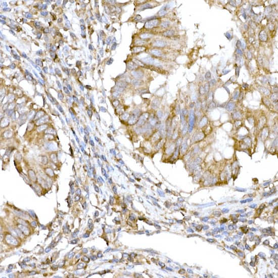 Immunohistochemistry: IRE1 alpha Antibody - Azide and BSA Free [IRE1 alpha] - Immunohistochemistry analysis of paraffin-embedded Human colon carcinoma using IRE1 alpha Rabbit pAb  at dilution of 1:100 (40x lens). High pressure antigen retrieval performed with 0.01M Citrate Bufferr (pH 6.0) prior to IHC staining.