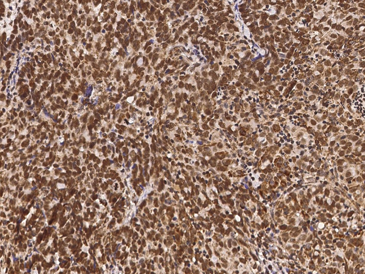 Immunohistochemistry-Paraffin: NAC1 Antibody [NBP2-98710] - Immunochemical staining of human NAC1 in human ovarian cancer with NBP2-98710 (1:2000, formalin-fixed paraffin embedded sections).