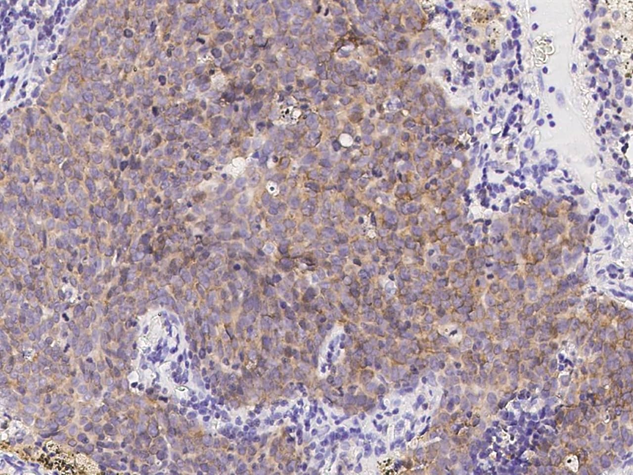 Immunohistochemistry-Paraffin: TTK Antibody [NBP2-98832] - Staining of human RPS27 in human lung cancer with NBP2-98832 (1:1000). 