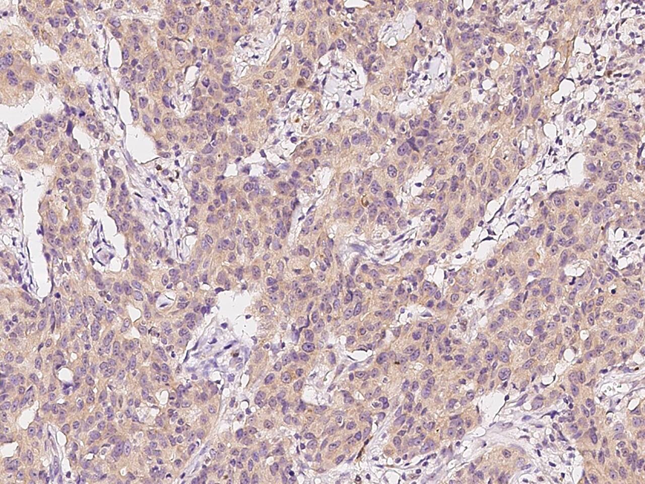 Immunohistochemistry-Paraffin: of NMT2 Antibody - BSA Free [NBP2-99170] - Immunochemical staining of NMT2 in human breast carcinoma with NBP2-99170 at 1:300 dilution, formalin-fixed paraffin embedded sections.