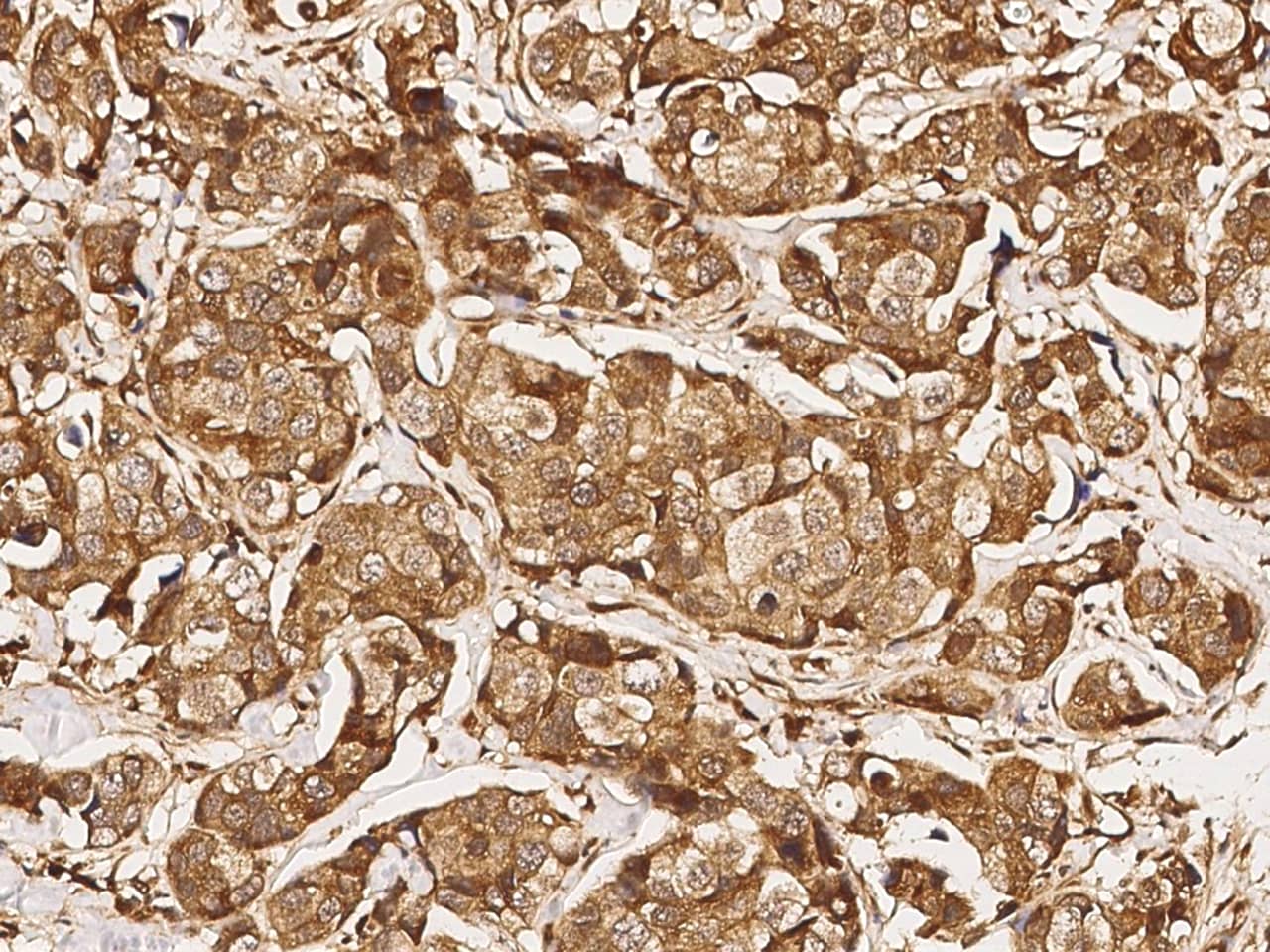 Immunohistochemistry-Paraffin: USP46 Antibody [NBP2-99882] - Immunochemical staining of human USP46 in human breast carcinoma with NBP2-99882 (1:1000, formalin-fixed paraffin embedded sections).