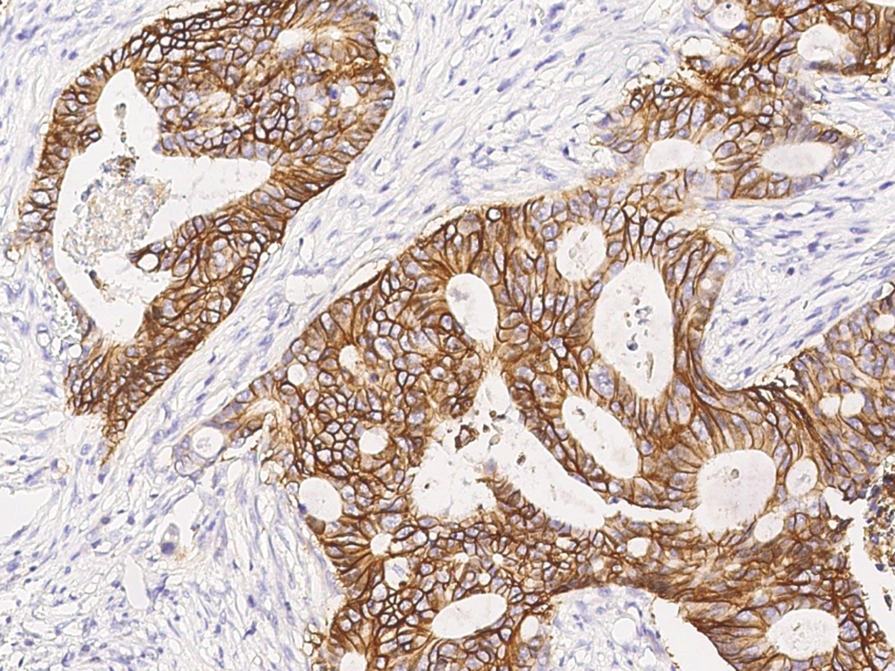 Immunohistochemistry-Paraffin: Sodium Potassium ATPase Beta 1 Antibody [NBP3-00261] - Immunochemical staining of human Sodium Potassium ATPase Beta 1 in human colon carcinoma with NBP3-00261 (1:2000, formalin-fixed paraffin embedded sections).