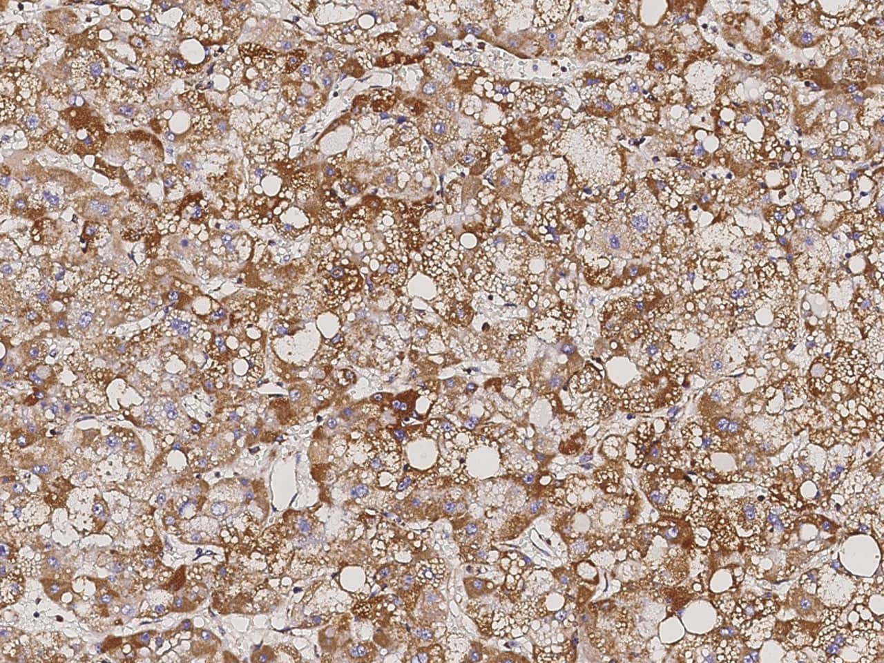 Immunohistochemistry-Paraffin: ATP5D Antibody [NBP3-00344] - Immunochemical staining of human ATP5D in human hepatoma with NBP3-00344 (1:5000, formalin-fixed paraffin embedded sections).