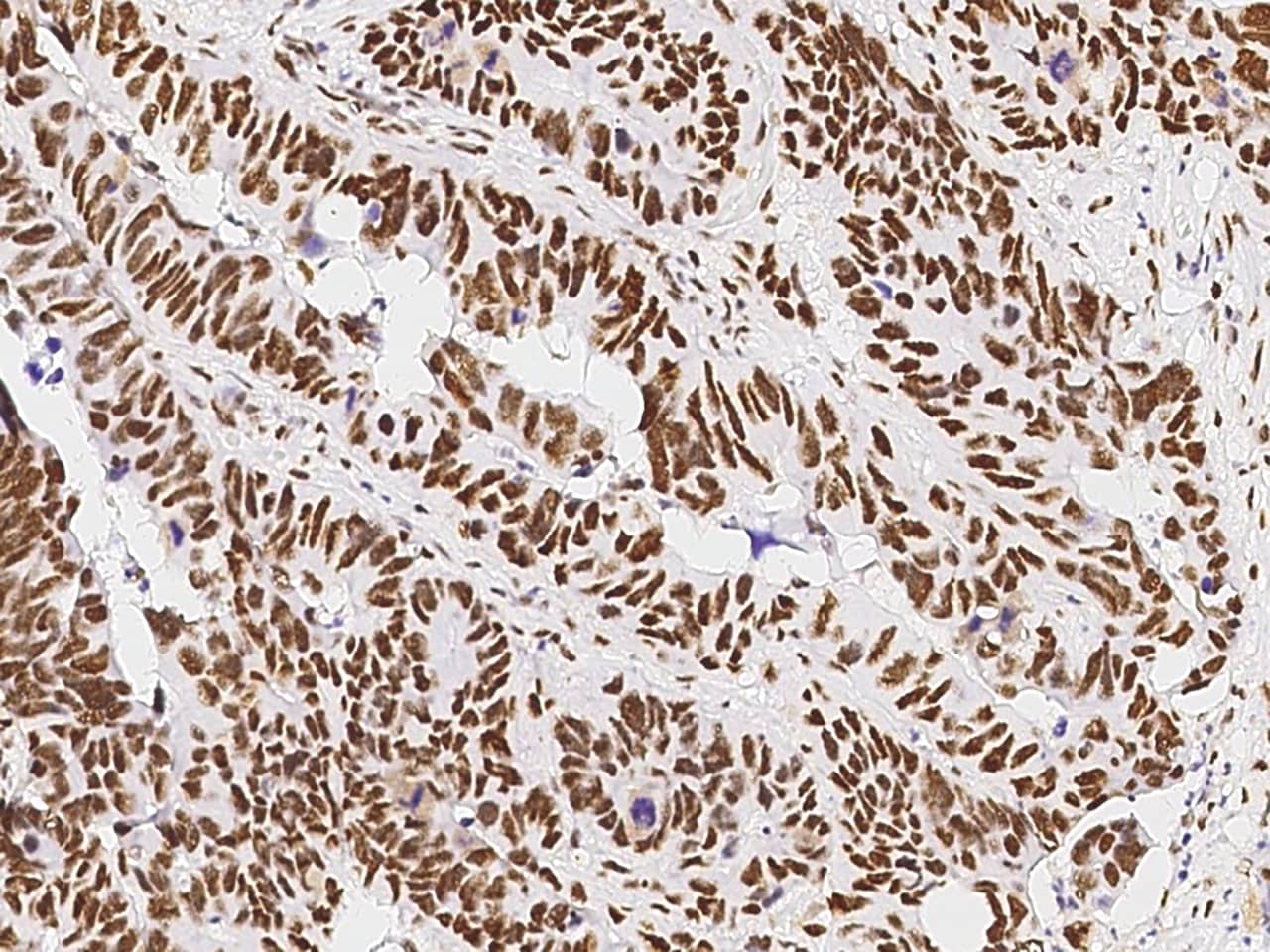 Immunohistochemistry-Paraffin: PA28 Activator gamma Subunit/PA28 Activator gamma Subunit/PSME3 Antibody [NBP3-00357] - Immunochemical staining of human PA28 Activator gamma Subunit/PSME3 in human colon carcinoma with NBP3-00357 at 1:10000 dilution, formalin-fixed paraffin embedded sections.