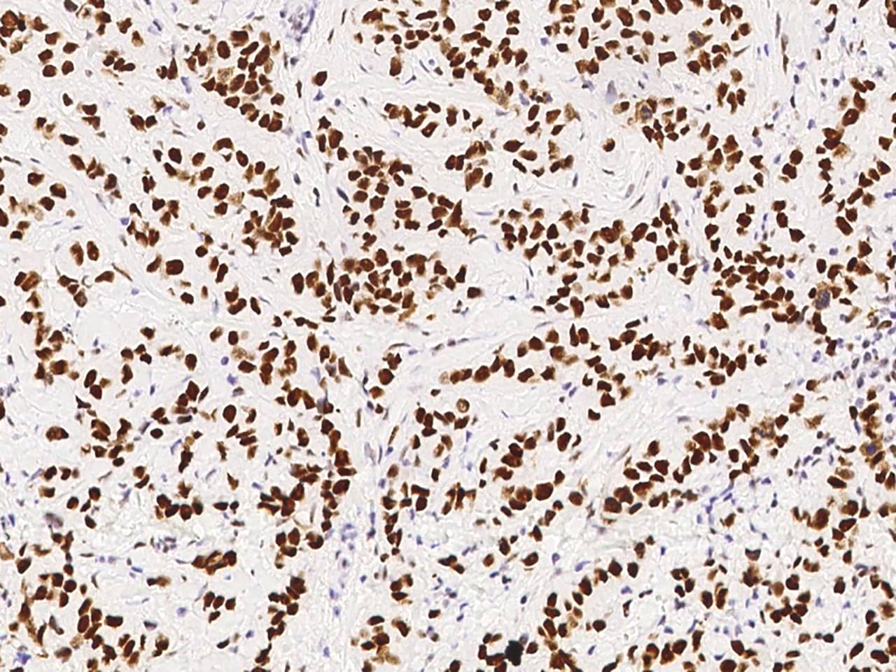 Immunohistochemistry-Paraffin: PA28 Activator gamma Subunit/PA28 Activator gamma Subunit/PSME3 Antibody [NBP3-00357] - Immunochemical staining of human PA28 Activator gamma Subunit/PSME3 in human breast carcinoma with NBP3-00357 at 1:10000 dilution, formalin-fixed paraffin embedded sections.