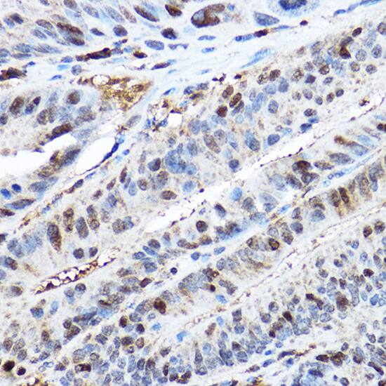 <b>Genetic Strategies Validation. </b>Immunohistochemistry: CDK2 Antibody - Azide and BSA Free [CDK2] - Immunohistochemistry analysis of paraffin-embedded Human colon carcinoma tissue using [KO Validated] CDK2 Rabbit pAb  at a dilution of 1:200 (40x lens). High pressure antigen retrieval performed with 0.01M Citrate Bufferr (pH 6.0) prior to IHC staining.