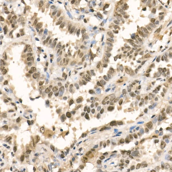 Immunohistochemistry: Methyltransferase like 3 Antibody - Azide and BSA Free [Methyltransferase like 3] - Immunohistochemistry analysis of paraffin-embedded Human lung cancer using Methyltransferase like 3 Rabbit pAb  at dilution of 1:100 (40x lens). High pressure antigen retrieval performed with 0.01M Citrate Bufferr (pH 6.0) prior to IHC staining.