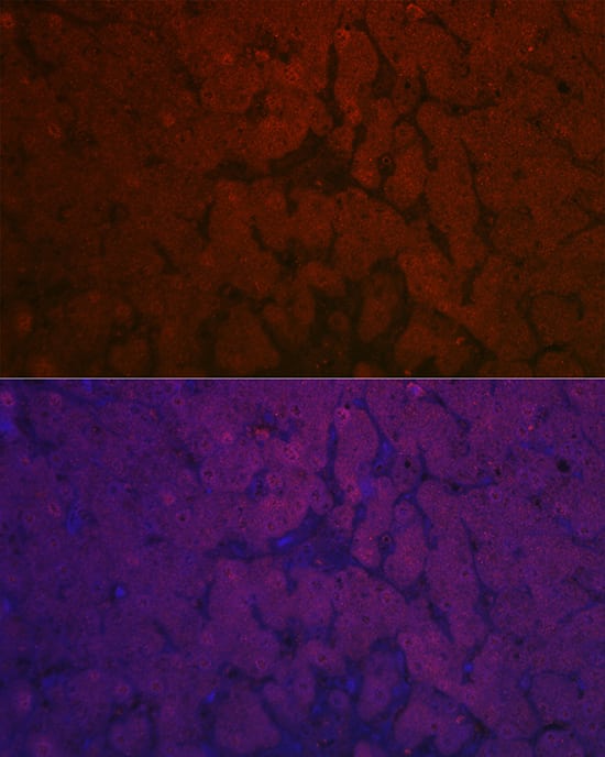 Immunocytochemistry/ Immunofluorescence: Nicotinamide N-Methyltransferase/NNMT Antibody - Azide and BSA Free [Nicotinamide N-Methyltransferase/NNMT] - Immunofluorescence analysis of paraffin-embedded human liver cancer using Nicotinamide N-Methyltransferase/NNMT Rabbit pAb  at dilution of 1:50 (40x lens). Secondary antibody: Cy3-conjugated Goat anti-Rabbit IgG (H+L)  at 1:500 dilution. Blue: DAPI for nuclear staining.
