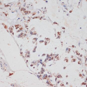 Immunohistochemistry: HIV-1 Tat specific factor 1 Antibody - BSA Free [HIV-1 Tat specific factor 1] - Immunohistochemistry analysis of paraffin-embedded Human gastric cancer using HIV-1 Tat specific factor 1 Rabbit pAb  at dilution of 1:100 (40x lens). Microwave antigen retrieval performed with 0.01M PBS Buffer (pH 7.2) prior to IHC staining.