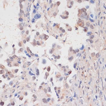 Immunohistochemistry: HIV-1 Tat specific factor 1 Antibody - BSA Free [HIV-1 Tat specific factor 1] - Immunohistochemistry analysis of paraffin-embedded Human lung cancer using HIV-1 Tat specific factor 1 Rabbit pAb  at dilution of 1:100 (40x lens). Microwave antigen retrieval performed with 0.01M PBS Buffer (pH 7.2) prior to IHC staining.