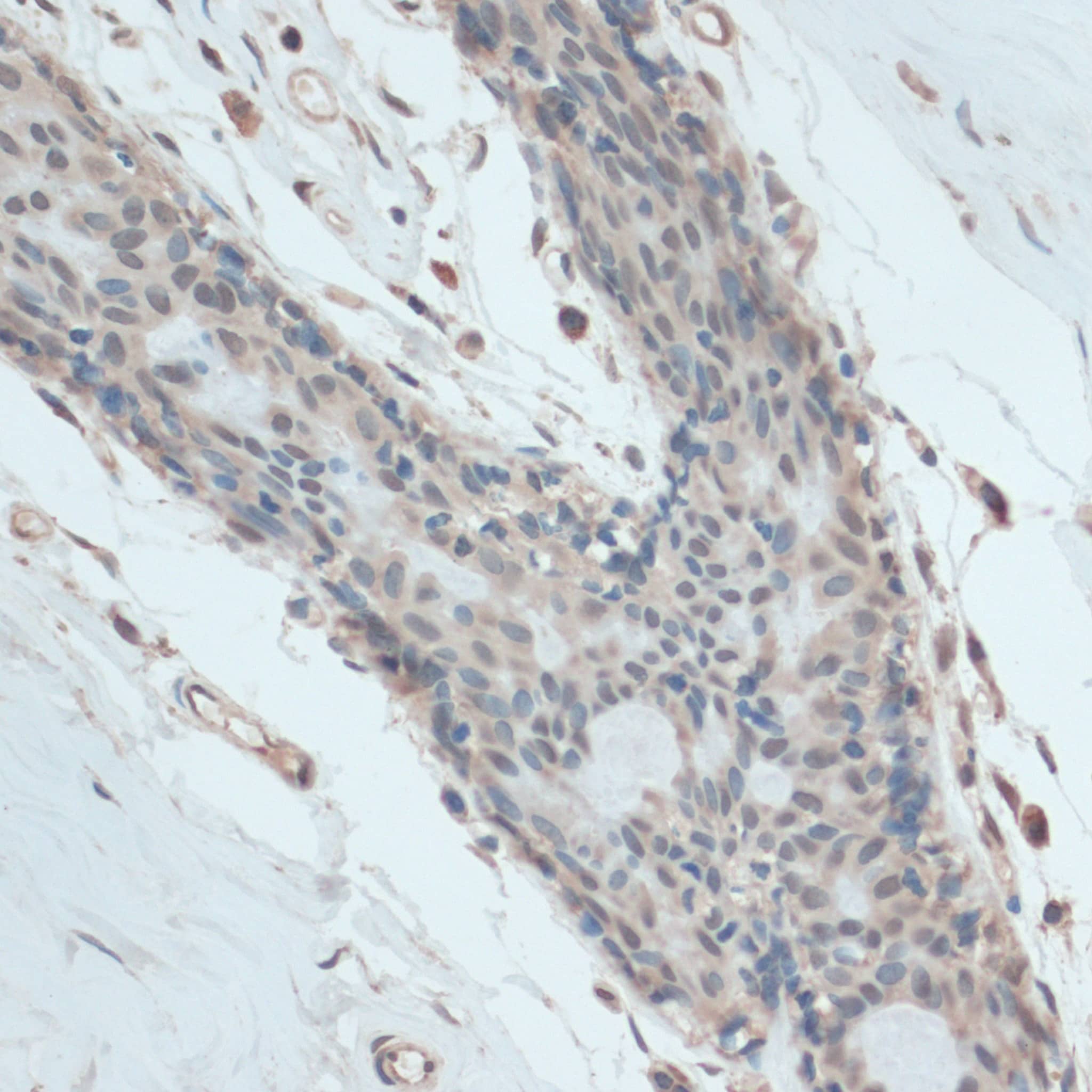 Immunohistochemistry: GAPDH-2 Antibody - BSA Free [GAPDH-2] - Immunohistochemistry analysis of paraffin-embedded human breast using GAPDH-2 Rabbit pAb  at dilution of 1:100 (40x lens).Perform microwave antigen retrieval with 10 mM PBS buffer pH 7.2 before commencing with IHC staining protocol