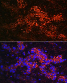 Immunocytochemistry/ Immunofluorescence: Ceruloplasmin Antibody - Azide and BSA Free [Ceruloplasmin] - Immunofluorescence analysis of paraffin-embedded Human liver cancer using Ceruloplasmin Rabbit pAb  at dilution of 1:100. Secondary antibody: Cy3-conjugated Goat anti-Rabbit IgG (H+L)  at 1:500 dilution. Blue: DAPI for nuclear staining.