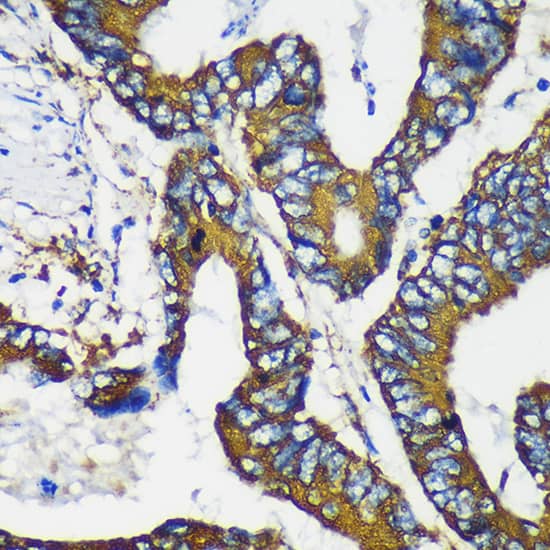 Immunohistochemistry: MKK4/MEK4 Antibody - BSA Free [MKK4/MEK4] - Immunohistochemistry analysis of paraffin-embedded Human colon cancer using MKK4/MEK4 Rabbit pAb  at dilution of  1:100 (40x lens). Microwave antigen retrieval performed with 0.01M PBS Buffer (pH 7.2) prior to IHC staining.