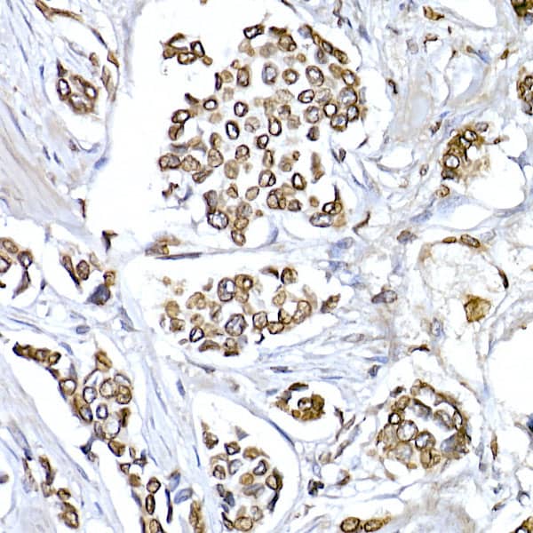 Immunohistochemistry: Lamin B1 Antibody - Azide and BSA Free [Lamin B1] - Immunohistochemistry analysis of paraffin-embedded Human breast cancer using Lamin B1 Rabbit pAb  at dilution of 1:150 (40x lens). High pressure antigen retrieval performed with 0.01M Citrate Bufferr (pH 6.0) prior to IHC staining.