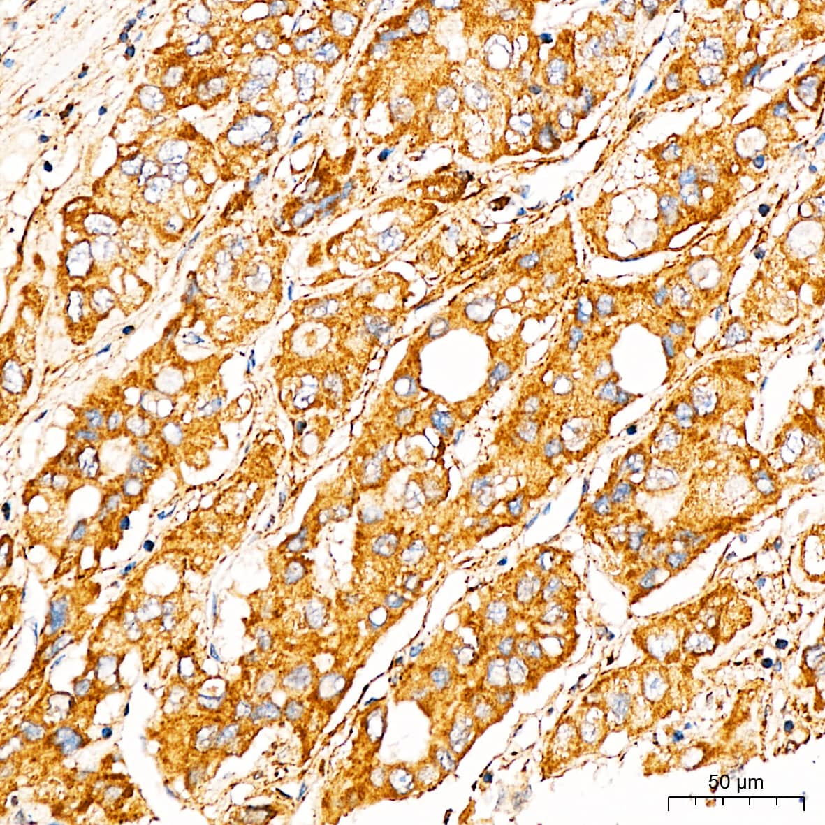 Immunohistochemistry: Frataxin Antibody - Azide and BSA Free [Frataxin] - Immunohistochemistry analysis of paraffin-embedded Human liver cancer tissue using Frataxin Rabbit pAb  at a dilution of 1:200 (40x lens). High pressure antigen retrieval performed with 0.01M Citrate Bufferr (pH 6.0) prior to IHC staining.