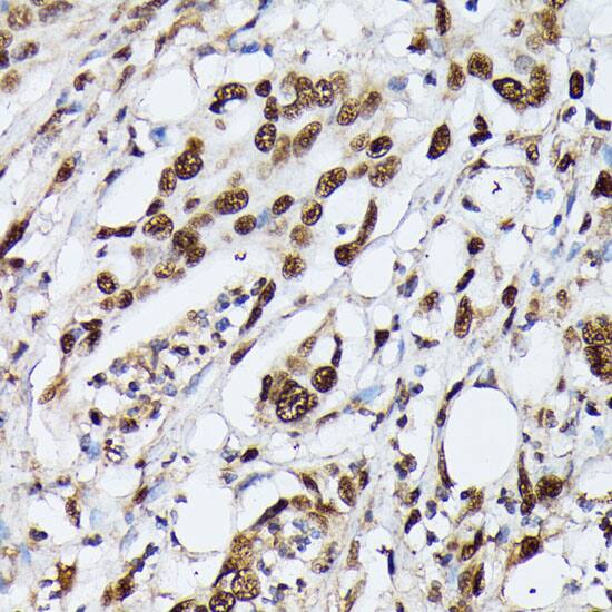 Immunohistochemistry: hnRNP M Antibody - Azide and BSA Free [hnRNP M] - Immunohistochemistry analysis of paraffin-embedded Human colon carcinoma using hnRNP M Rabbit pAb  at dilution of 1:100 (40x lens). Microwave antigen retrieval performed with 0.01M PBS Buffer (pH 7.2) prior to IHC staining.