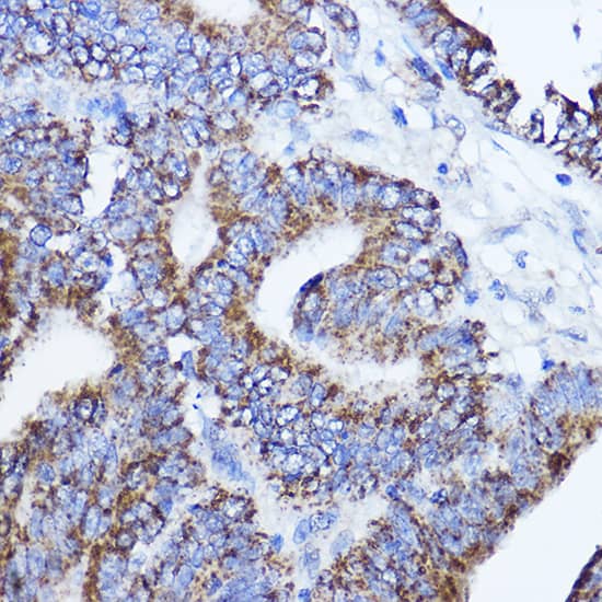 Immunohistochemistry: LRPPRC Antibody - BSA Free [LRPPRC] - Immunohistochemistry analysis of paraffin-embedded human colon carcinoma using LRPPRC Rabbit pAb  at dilution of 1:200 (40x lens).Perform microwave antigen retrieval with 10 mM PBS buffer pH 7.2 before commencing with IHC staining protocol.