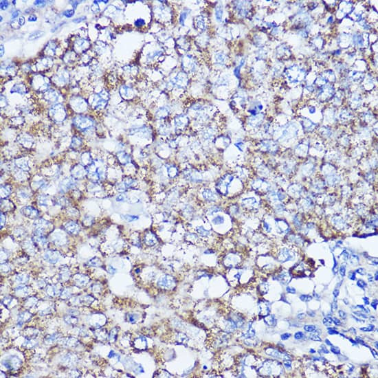 Immunohistochemistry: LRPPRC Antibody - BSA Free [LRPPRC] - Immunohistochemistry analysis of paraffin-embedded human breast cancer using LRPPRC Rabbit pAb  at dilution of 1:200 (40x lens).Perform microwave antigen retrieval with 10 mM PBS buffer pH 7.2 before commencing with IHC staining protocol.