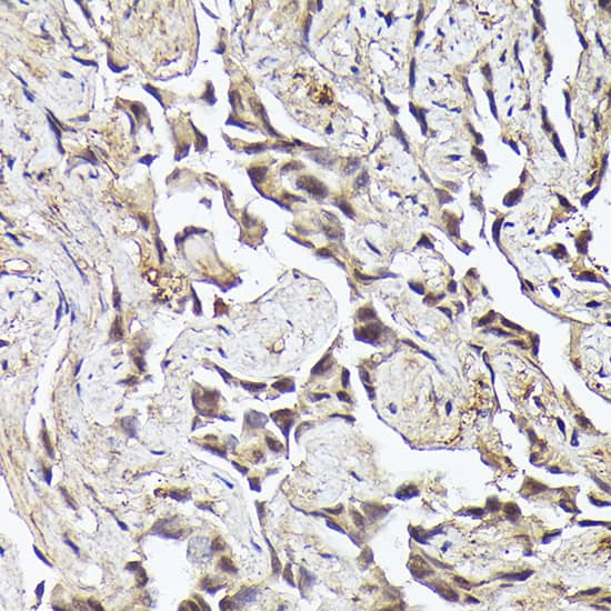 Immunohistochemistry: METTL4 Antibody - Azide and BSA Free [METTL4] - Immunohistochemistry analysis of paraffin-embedded Human lung cancer using METTL4 Rabbit pAb  at dilution of 1:50 (40x lens). Perform high pressure antigen retrieval with 10 mM citrate buffer pH 6.0 before commencing with IHC staining protocol.