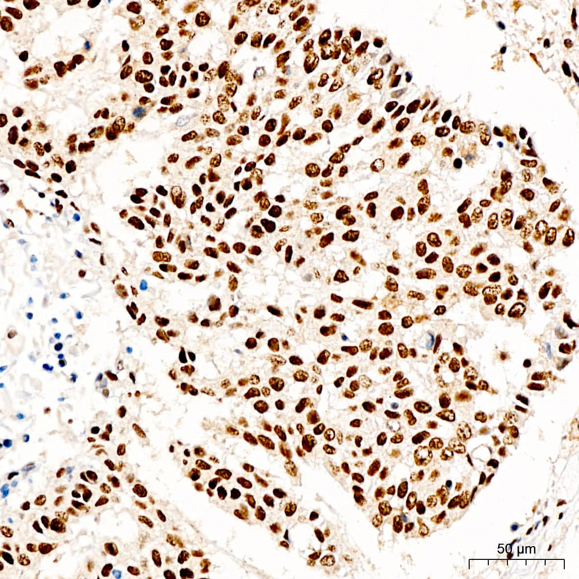 Immunohistochemistry: KLHDC2 Antibody - Azide and BSA Free [KLHDC2] - Immunohistochemistry analysis of paraffin-embedded Human lung cancer tissue using KLHDC2 Rabbit pAb  at a dilution of 1:200 (40x lens). High pressure antigen retrieval performed with 0.01M Citrate Buffer(pH 6.0) prior to IHC staining.