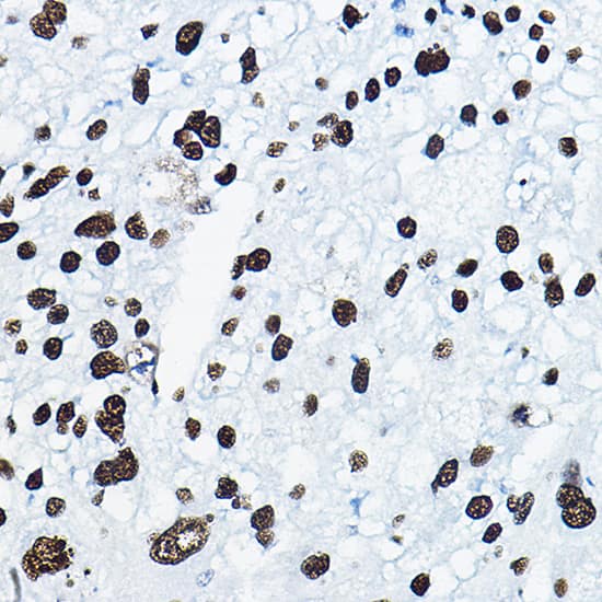 Immunohistochemistry: Mkl1 Antibody - BSA Free [Mkl1] - Immunohistochemistry analysis of paraffin-embedded Human liver cancer using Mkl1 Rabbit pAb  at dilution of 1:100 (40x lens).Perform microwave antigen retrieval with 10 mM PBS buffer pH 7.2 before commencing with IHC staining protocol.