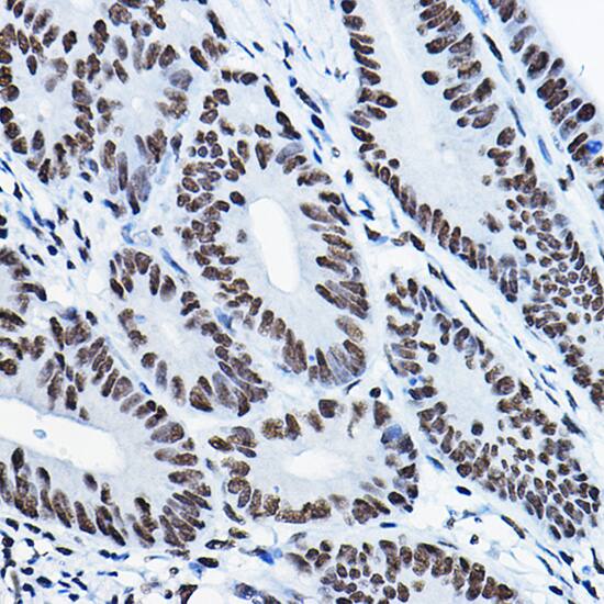 Immunohistochemistry: Mkl1 Antibody - BSA Free [Mkl1] - Immunohistochemistry analysis of paraffin-embedded Human colon carcinoma using Mkl1 Rabbit pAb  at dilution of 1:100 (40x lens).Perform microwave antigen retrieval with 10 mM PBS buffer pH 7.2 before commencing with IHC staining protocol.