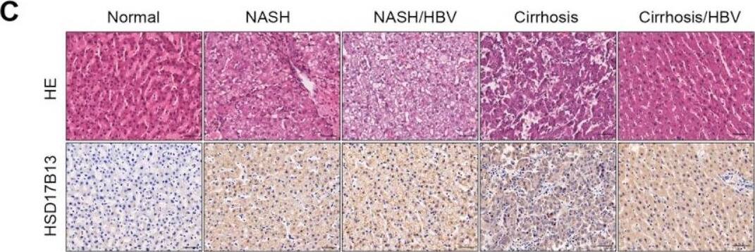 HSD17B13 expression is increased in the liver tissues of patients and murine models with NAFLD. (A–C) Representative H&E and immunohistochemical staining and the statistical summary in a human liver tissue array (A), the results were re-distinguished between man and woman (B), the results were re-distinguished with or without HBV infection (C). (D) C57BL/6 mice or SD rats were treated with pathogenic agents accordingly. Representative H&E and immunohistochemical staining of the murine livers. (E,F) mRNA (E) and protein (F) in the murine livers were measured by qRT-PCR and Western blotting, respectively. Results are expressed as mean +/- SEM. (scale bars, 50 μm). NASH, non-alcoholic steatohepatitis; HCC, hepatocellular carcinoma; HBV, hepatitis B virus; MCD, methionine choline deficient diet; CDHFD, choline deficient and high-fat diet; HFD, high-fat diet; DEN, diethylnitrosamine; CCl4, carbon tetrachloride; BDL, bile-duct ligation. Image collected and cropped by CiteAb from the following open publication (//pubmed.ncbi.nlm.nih.gov/35628360), licensed under a CC-BY license. Not internally tested by Novus Biologicals.