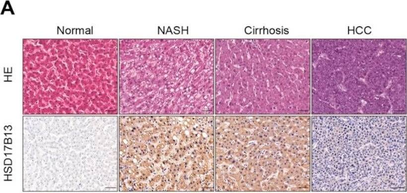 HSD17B13 expression is increased in the liver tissues of patients and murine models with NAFLD. (A–C) Representative H&E and immunohistochemical staining and the statistical summary in a human liver tissue array (A), the results were re-distinguished between man and woman (B), the results were re-distinguished with or without HBV infection (C). (D) C57BL/6 mice or SD rats were treated with pathogenic agents accordingly. Representative H&E and immunohistochemical staining of the murine livers. (E,F) mRNA (E) and protein (F) in the murine livers were measured by qRT-PCR and Western blotting, respectively. Results are expressed as mean +/- SEM. (scale bars, 50 μm). NASH, non-alcoholic steatohepatitis; HCC, hepatocellular carcinoma; HBV, hepatitis B virus; MCD, methionine choline deficient diet; CDHFD, choline deficient and high-fat diet; HFD, high-fat diet; DEN, diethylnitrosamine; CCl4, carbon tetrachloride; BDL, bile-duct ligation. Image collected and cropped by CiteAb from the following open publication (//pubmed.ncbi.nlm.nih.gov/35628360), licensed under a CC-BY license. Not internally tested by Novus Biologicals.