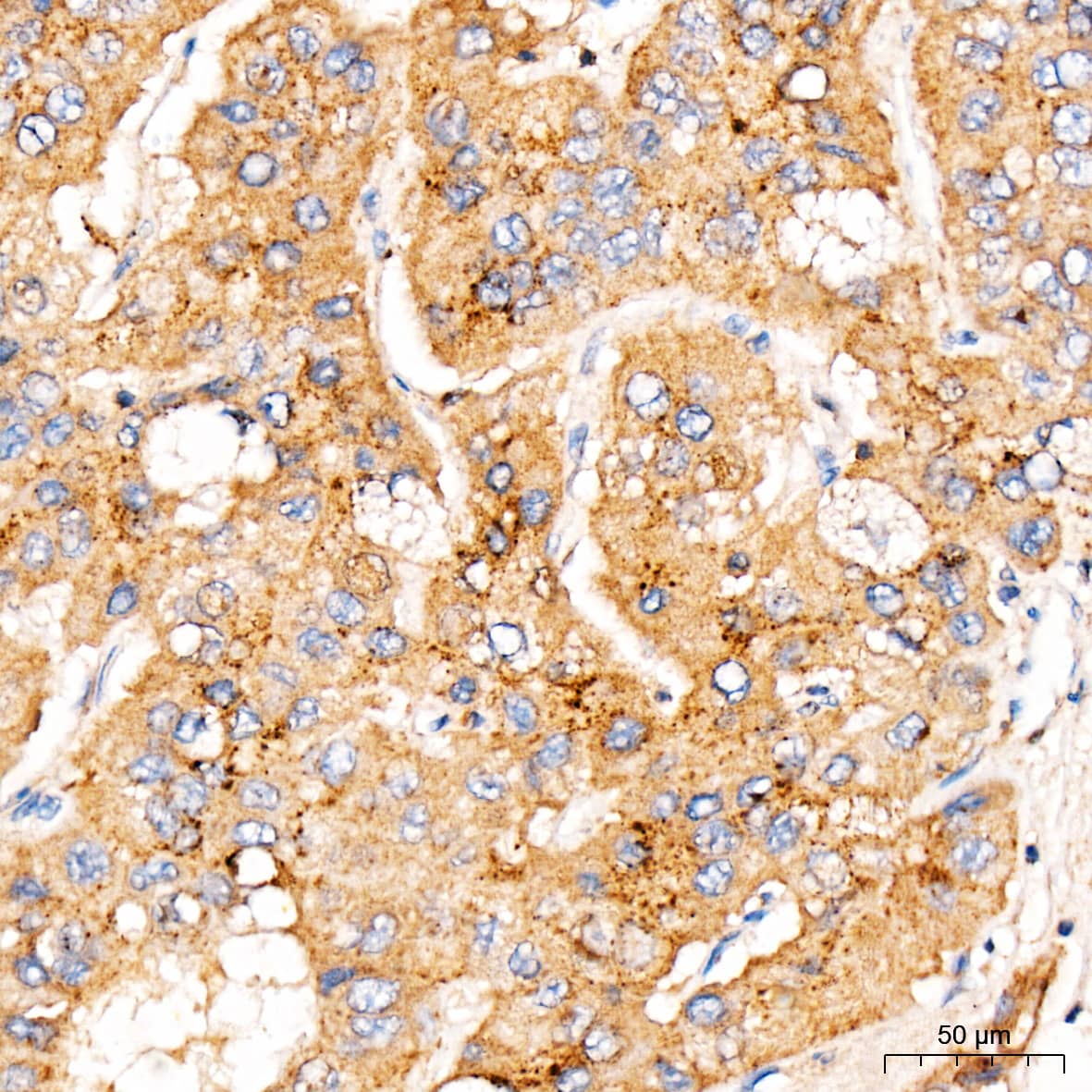 Immunohistochemistry: MBTPS1 Antibody - Azide and BSA Free [MBTPS1] - Immunohistochemistry analysis of paraffin-embedded Human liver cancer tissue using MBTPS1 Rabbit pAb  at a dilution of 1:100 (40x lens). High pressure antigen retrieval was performed with 0.01 M citrate buffer (pH 6.0) prior to IHC staining.