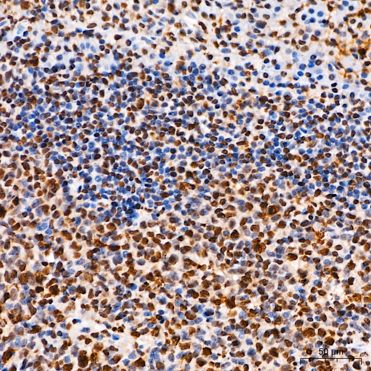 Immunohistochemistry: Elk-1 [p Ser383] Antibody - BSA Free [Elk-1] - Immunohistochemistry analysis of paraffin-embedded Human tonsil tissue using Elk-1 Rabbit pAb  at a dilution of 1:200 (40x lens). High pressure antigen retrieval performed with 0.01M Citrate Buffer(pH 6.0) prior to IHC staining.