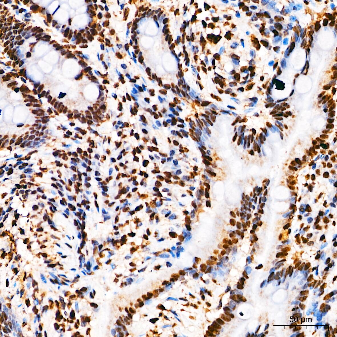 Immunohistochemistry: Elk-1 [p Ser383] Antibody - BSA Free [Elk-1] - Immunohistochemistry analysis of paraffin-embedded Human colon tissue using Elk-1 Rabbit pAb  at a dilution of 1:200 (40x lens). High pressure antigen retrieval performed with 0.01M Citrate Buffer(pH 6.0) prior to IHC staining.