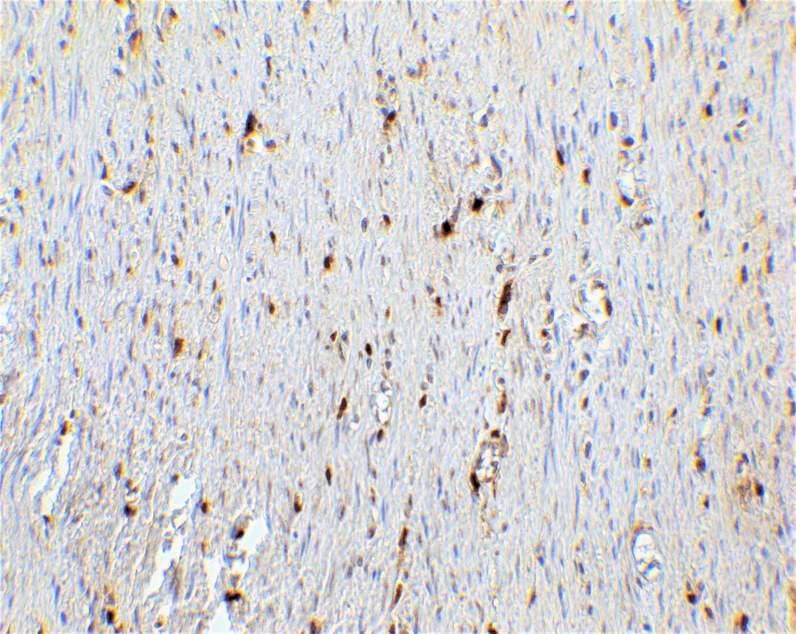 Immunohistochemistry: p16INK4a/CDKN2A Antibody - BSA Free [NBP3-06986] - Validation of p16INK4a/CDKN2A in Human Colon Tissue. Immunohistochemical analysis of paraffin-embedded human colon tissue using anti-p16INK4a/CDKN2A antibody  at 5 ug/ml. Tissue was fixed with formaldehyde and blocked with 10% serum for 1 h at RT; antigen retrieval was by heat mediation with a citrate buffer (pH6). Samples were incubated with primary antibody overnight at 4C. A goat anti-rabbit IgG H&L (HRP) at 1/250 was used as secondary. Counter stained with Hematoxylin.