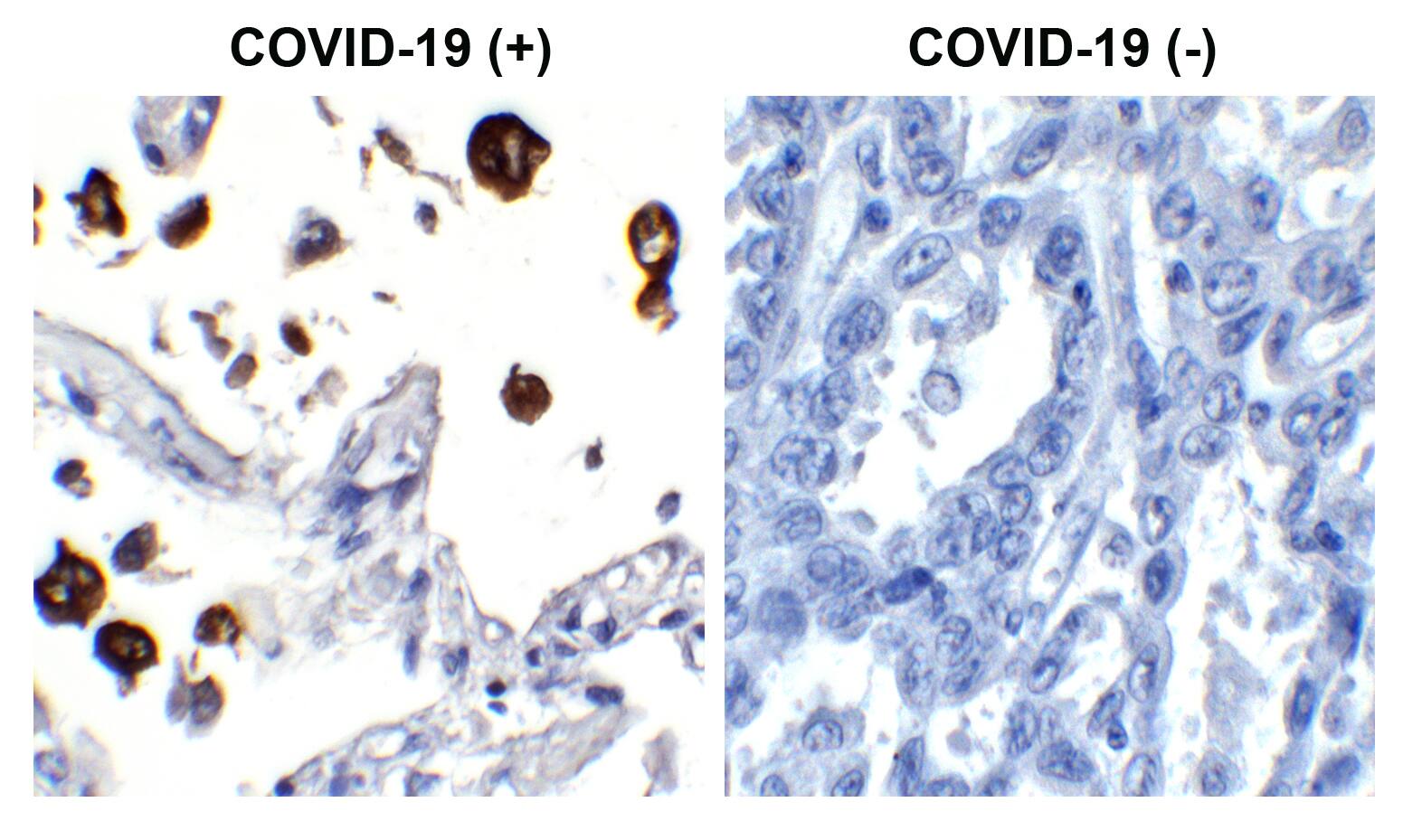 Immunohistochemistry: SARS-CoV-2 Nucleocapsid Antibody (84C4a) [NBP3-07041] - Figure 1 Immunohistochemistry Validation of SARS-CoV-2 (COVID-19) Nucleocapsid  in COVID-19 Patient Lung Immunohistochemical analysis of paraffin-embedded COVID-19 patient lung tissue using anti- SARS-CoV-2 (COVID-19) Nucleocapsid  antibody (, 5 ng/mL). Tissue was fixed with formaldehyde and blocked with 10% serum for 1 h at RT; antigen retrieval was by heat mediation with a citrate buffer (pH6). Samples were incubated with primary antibody overnight at 4C. A goat anti-rabbit IgG H&L (HRP) at 1/250 was used as secondary. Counter stained with Hematoxylin. Strong signal of SARS-COV-2 Nucleocapsid protein was observed in the macrophages of COVID-19 patient lung, but not in non-COVID-19 patient lung.